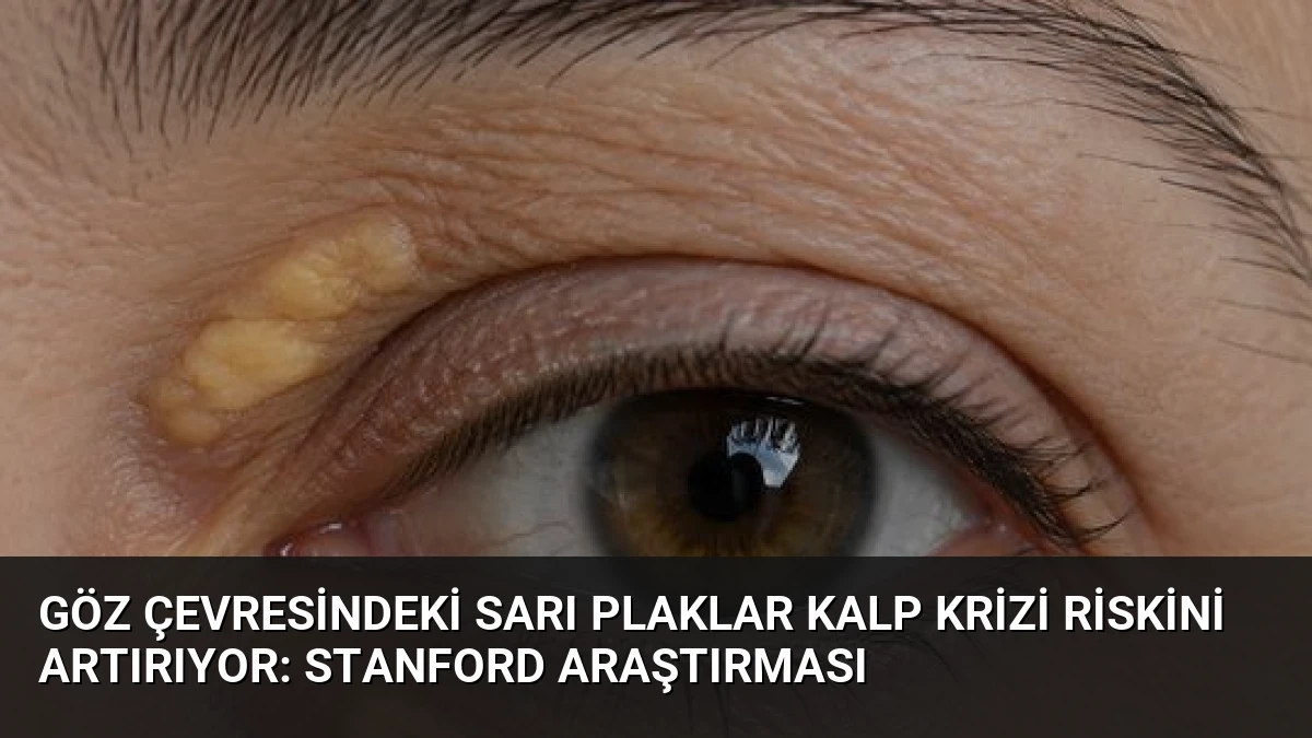 Göz Çevresindeki Sarı Plaklar Kalp Krizi Riskini Artırıyor: Stanford Araştırması
