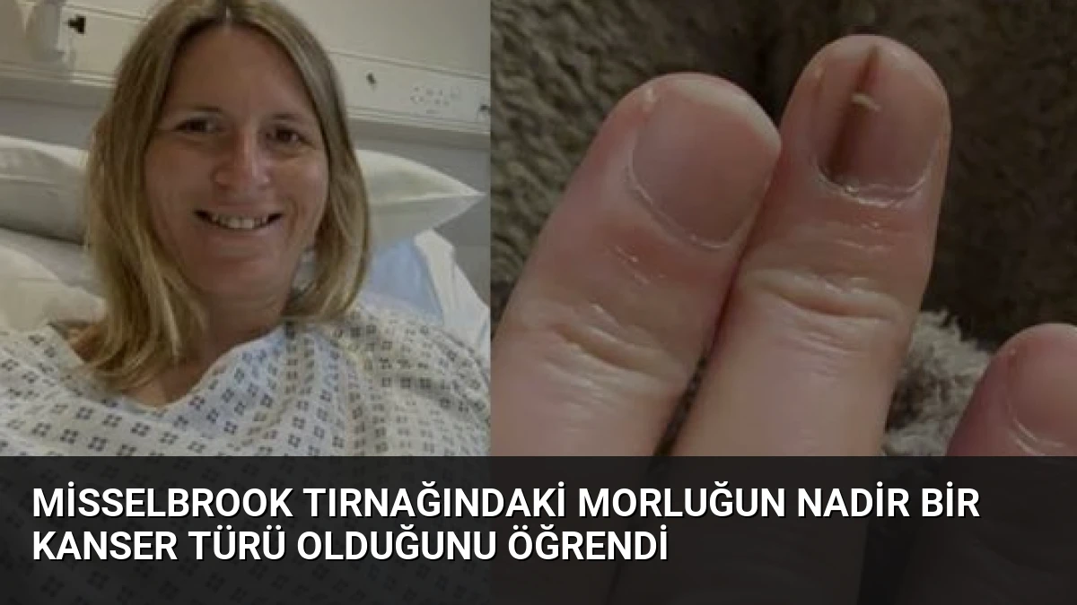 Misselbrook Tırnağındaki Morluğun Nadir Bir Kanser Türü Olduğunu Öğrendi