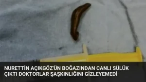 Nurettin Açıkgöz’ün Boğazından Canlı Sülük Çıktı Doktorlar Şaşkınlığını Gizleyemedi