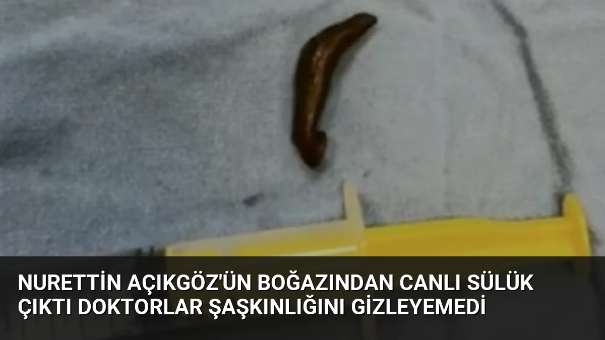 Nurettin Açıkgöz’ün Boğazından Canlı Sülük Çıktı Doktorlar Şaşkınlığını Gizleyemedi