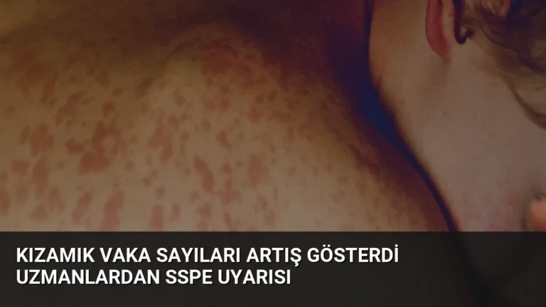 Kızamık Vaka Sayıları Artış Gösterdi Uzmanlardan SSPE Uyarısı