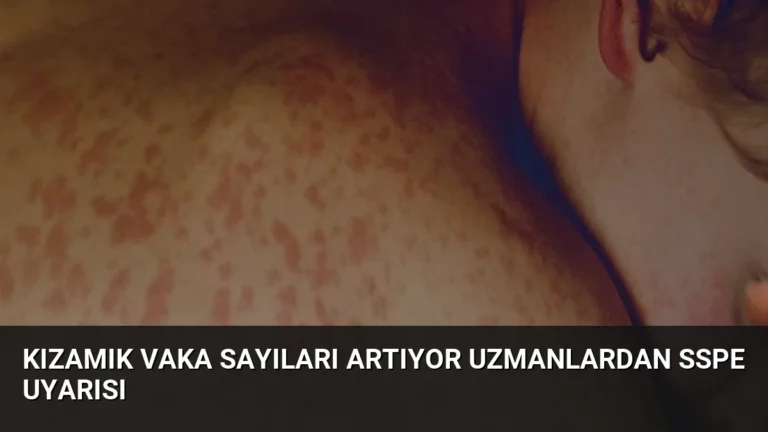Kızamık Vaka Sayıları Artıyor Uzmanlardan SSPE Uyarısı