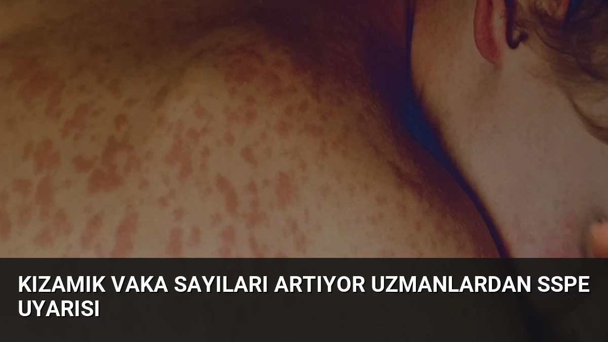 Kızamık Vaka Sayıları Artıyor Uzmanlardan SSPE Uyarısı