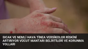 Sıcak ve Nemli Hava Tinea Versikolor Riskini Artırıyor Vücut Mantarı Belirtileri ve Korunma Yolları