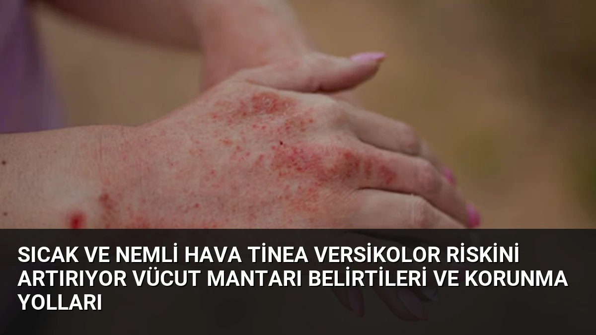 Sıcak ve Nemli Hava Tinea Versikolor Riskini Artırıyor Vücut Mantarı Belirtileri ve Korunma Yolları